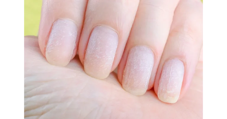Home Remedies for nail treatment