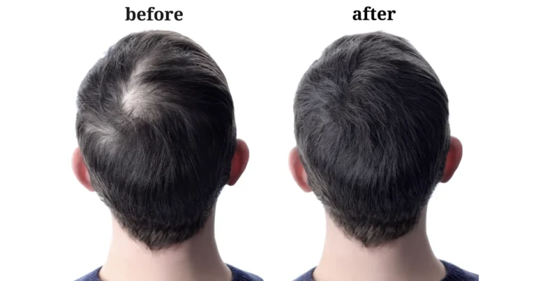 Recipes to Treat Hair Loss