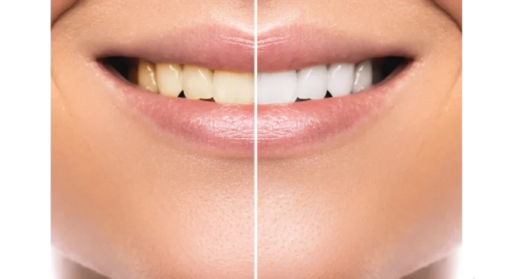 Natural Recipes for Teeth Whitening