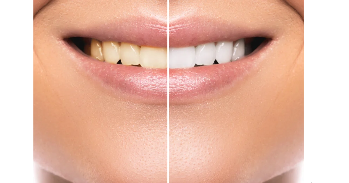 Natural Recipes for Teeth Whitening